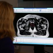 More men in Dorset were diagnosed with prostate cancer in 2022, new figures show